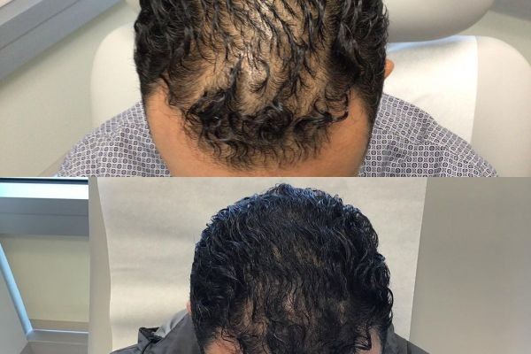 Expert Guide to Hair Transplant in Dubai