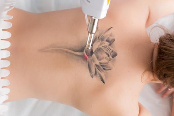 Tattoo Removal in Islamabad: Common Myths You Should Stop Believing