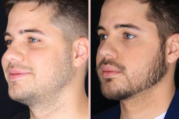 Fuller Facial Hair: Beard Hair Transplant in Dubai