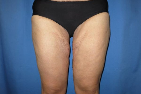 Discover the Benefits of Thigh Lift in Dubai for Body Confidence | Complete Guide