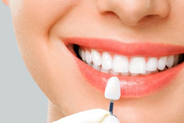 Veneers in Islamabad: A Complete Guide for First-Time Patients