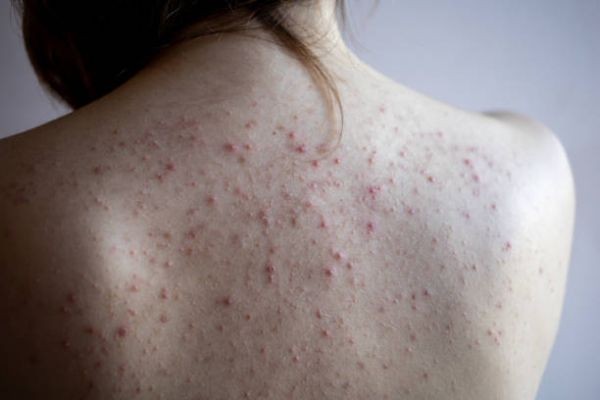 How to Treat Back Acne with a Simple Shower and Laundry Plan