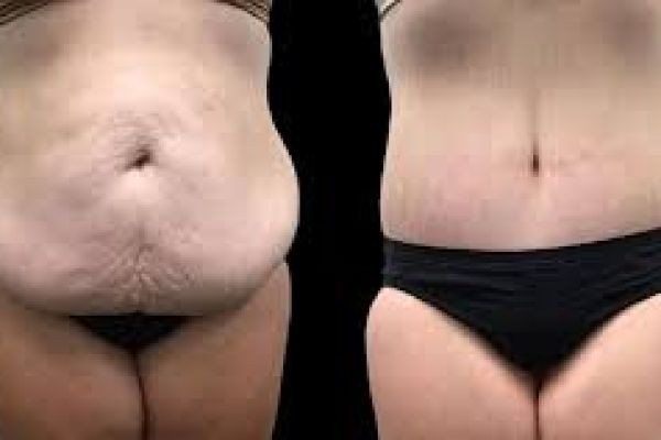 Post-Weight Loss Surgery in Dubai | Benefits & Recovery