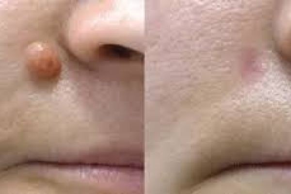 Mole Removal in Dubai: Consultation, Treatment and Recovery