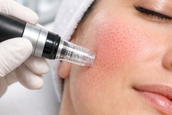 Dermapen Microneedling Device in Dubai: Ultimate Radiance Guide