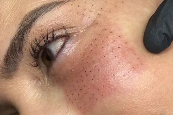 Plasma Pen Treatment in Dubai: Expert Insights
