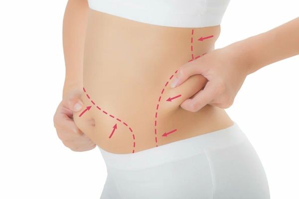 Tummy Tuck in Islamabad: How Abdominal Skin Quality Influences Your Surgical Results