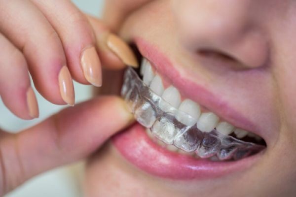 Suresmile Aligners: Improve Teeth Alignment With Advanced Technology
