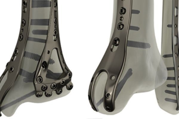 Bone Fixation Plates Market Pain Points Understanding Industry Challenges