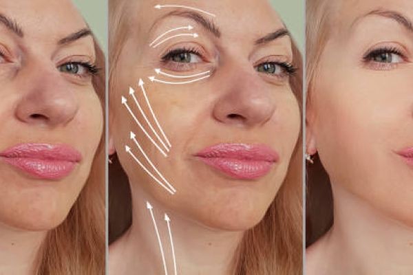Sculptra Fillers in Dubai: Ideal Candidates & Candidacy Guide
