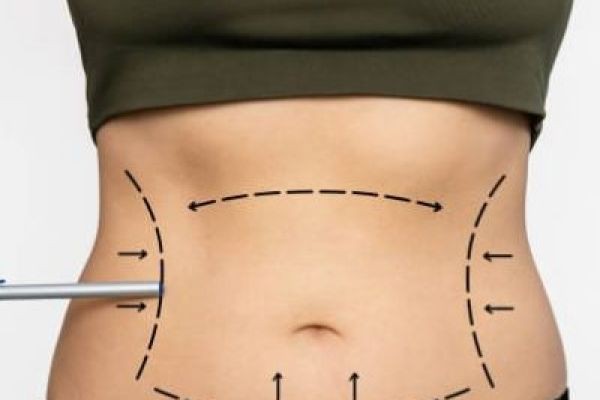 Liposuction Surgery in Dubai: Procedure & Recovery