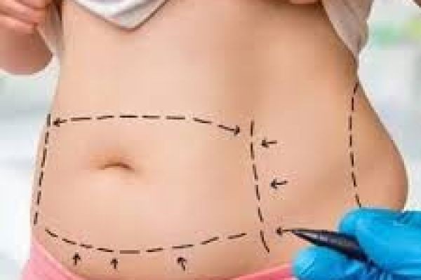 Liposuction Surgery in Dubai | Modern Fat Reduction & Body Contouring