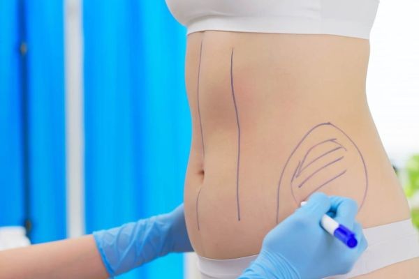 Laser Liposuction Dubai Recovery Tips and Timeline
