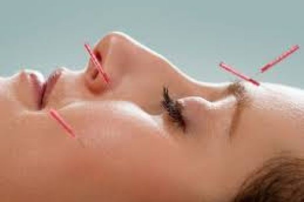 Acupuncture Treatment in Dubai | Pain & Stress Relief Therapy