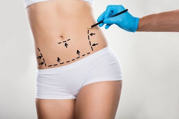 Tummy Tuck in Dubai: Restore Midsection Tone