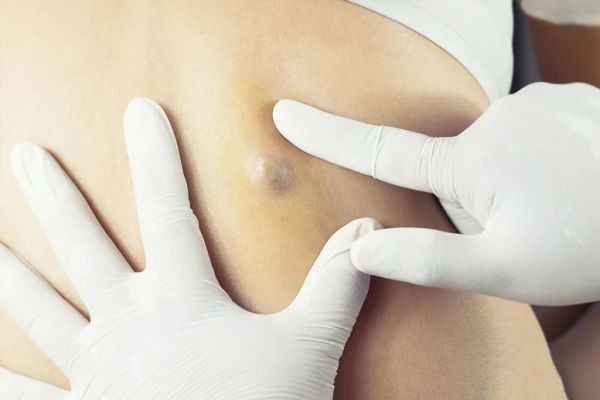 How Do You Begin Looking for Lipoma Treatment in Dubai?