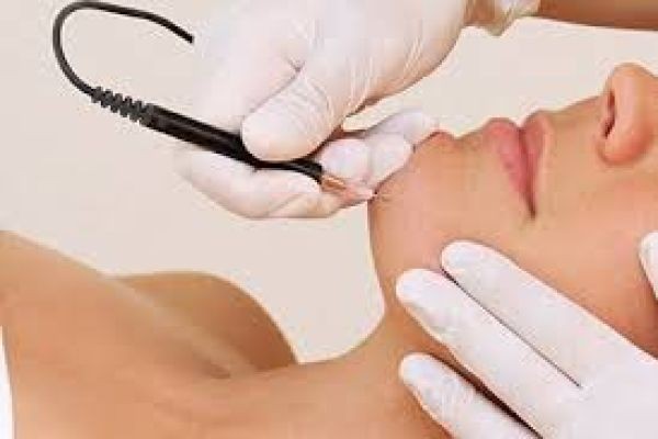 Electrolysis Hair Removal in Dubai | Is It Right for You?