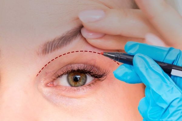 Eyelid Surgery in Islamabad: How Advanced Techniques Redefine Facial Expression and Harmony