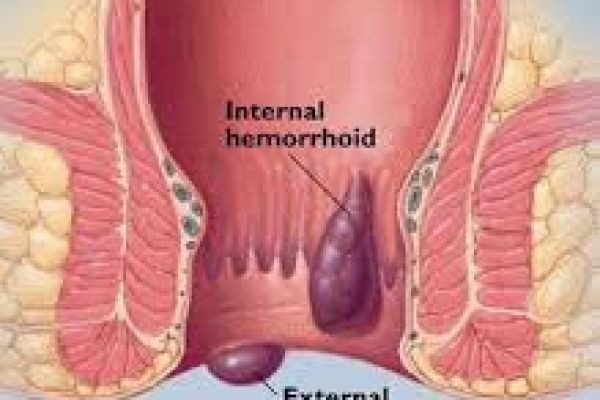 Advanced Haemorrhoids Treatment in Dubai for Effective Relief