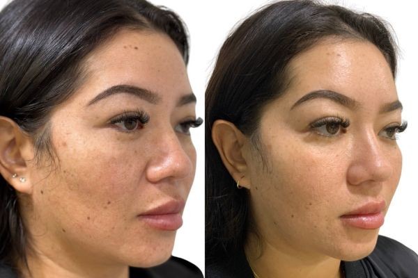 What Happens to Your Skin After a Skinbooster Treatment? A Week-by-Week Guide for First-Time Patients