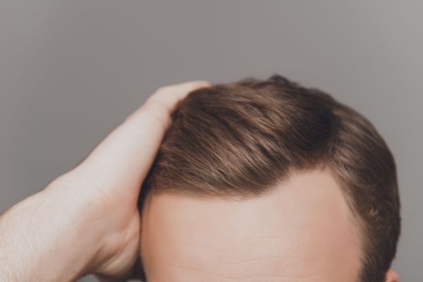 What Influences the Overall Outcome of Hair Transplant in Dubai?