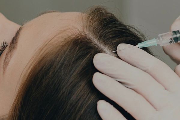 Understanding Graft Distribution in Female Hair Transplant in Dubai