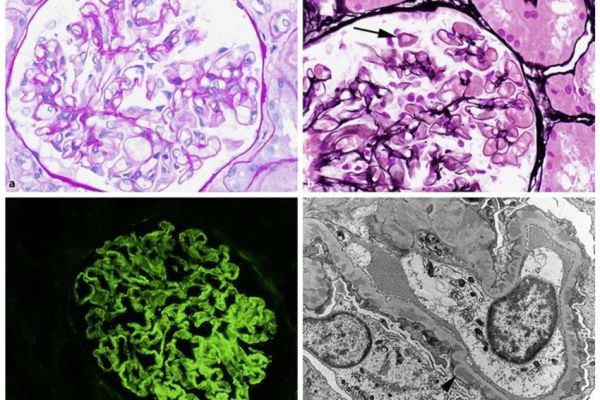 What Are the Key Signs of IgAN, Membranous Nephropathy, and APOL1 Kidney Disease?